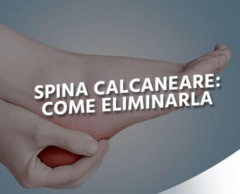 come eliminare spina calcaneare